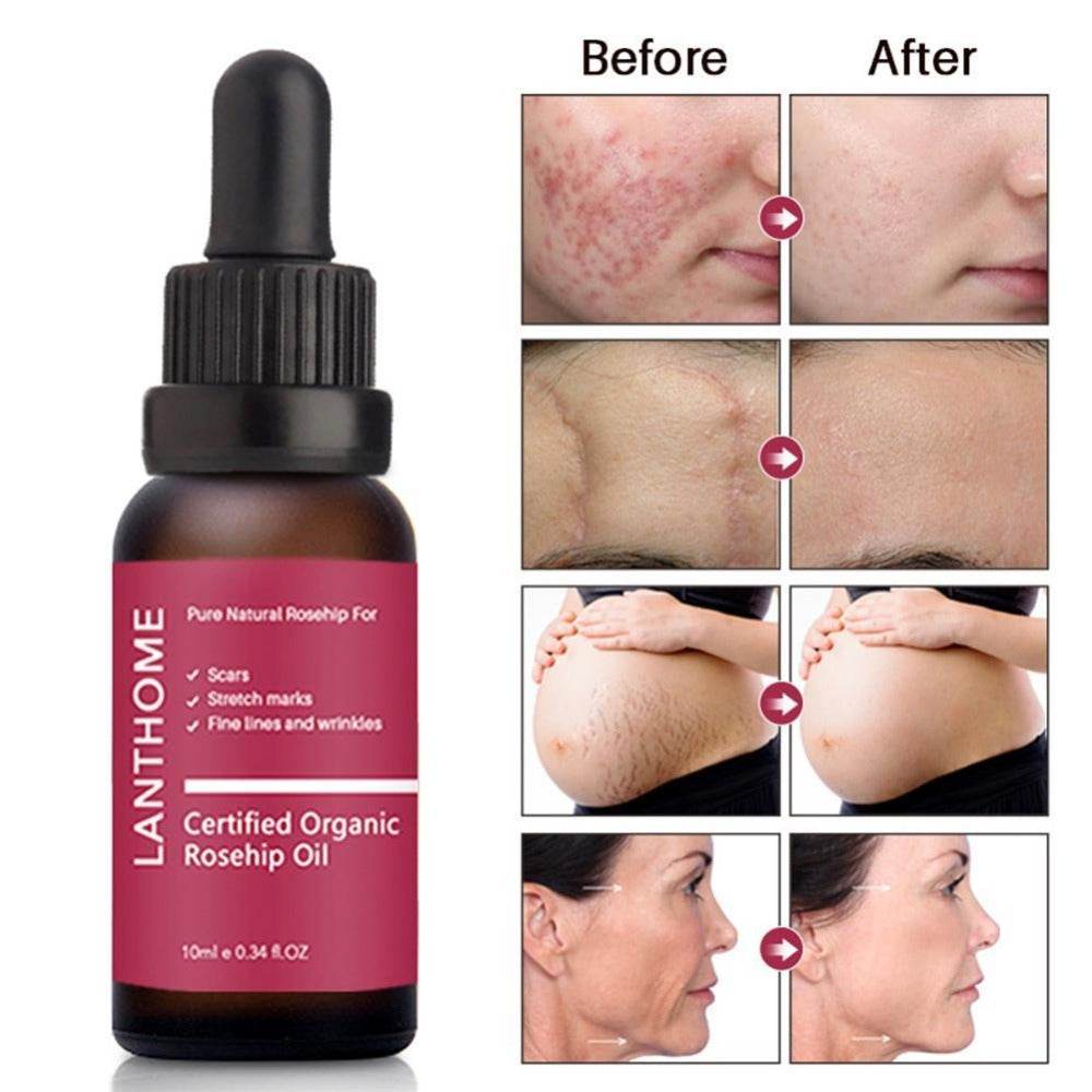 Moisturizing and moisturizing rosehip oil - Mubimart
