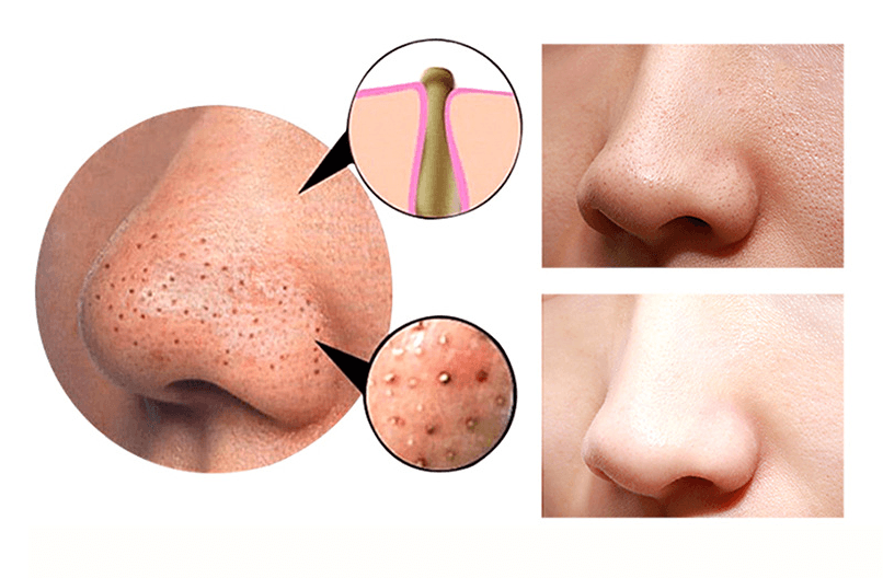 4 in 1 Body Guasha Cupping Blackhead Remover Machine Facial Pore Deep Cleansing Beauty Skin Care - Mubimart