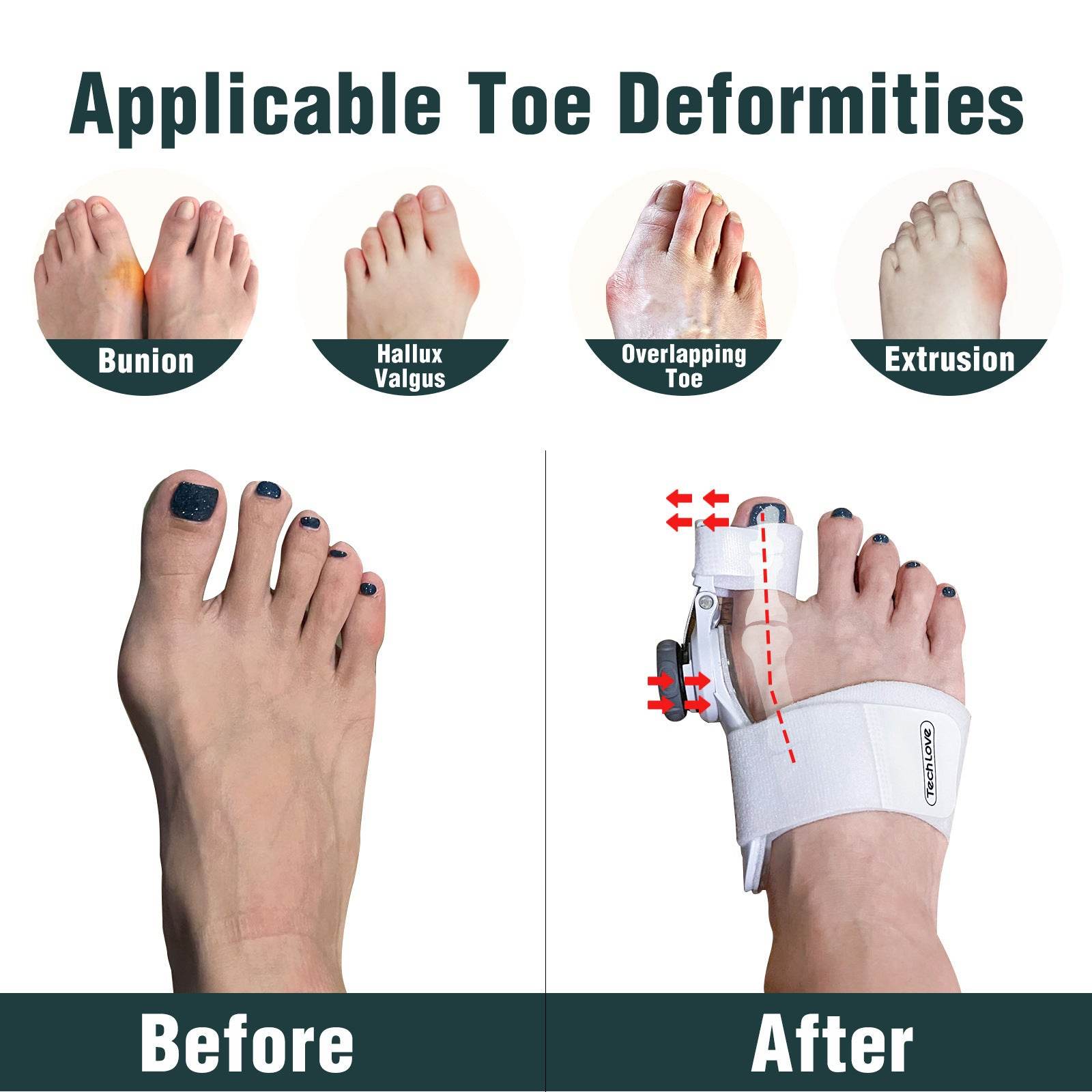 Toe Separator Night Toe Rectifier - Mubimart