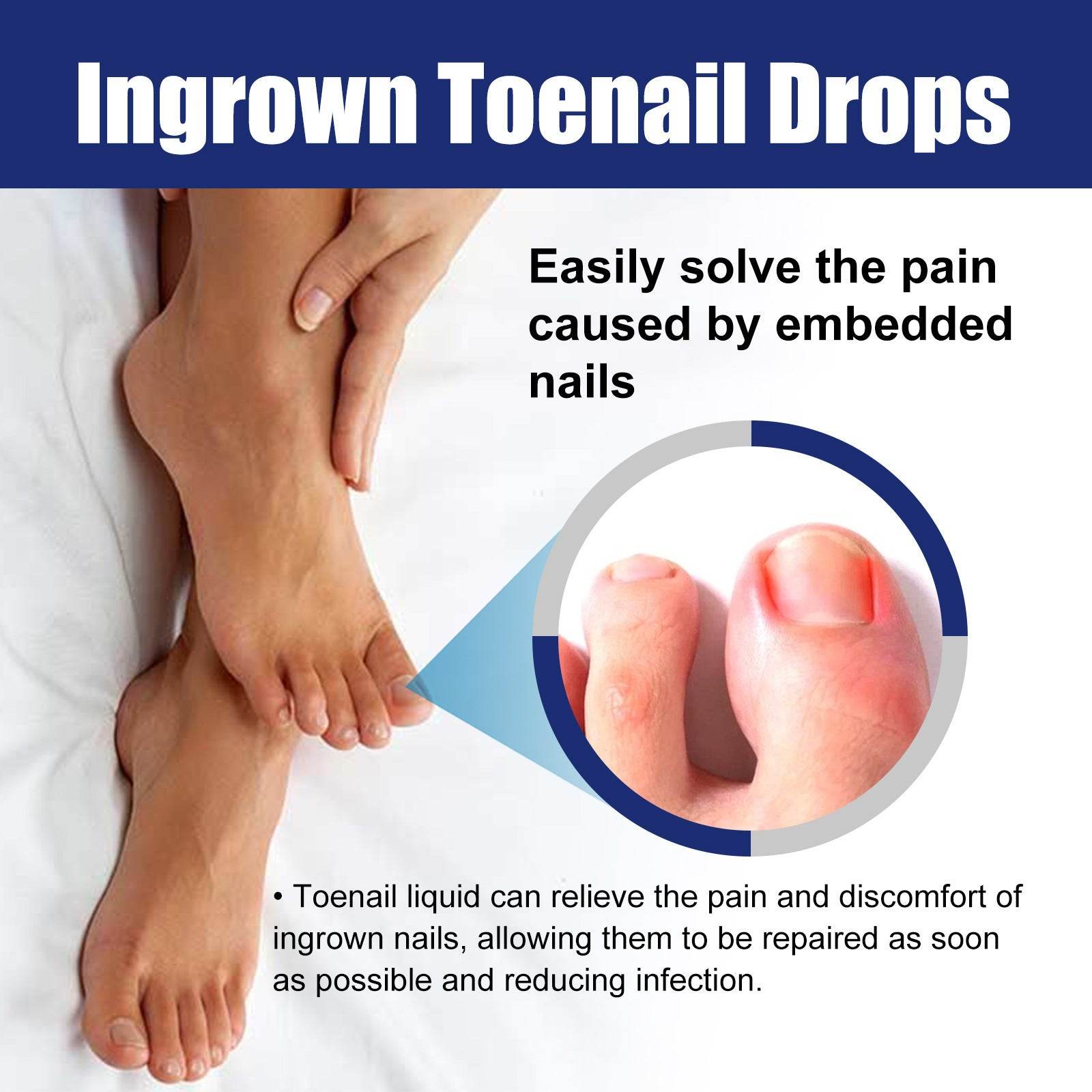Embedded Nail Repair Skin Moisturizing Lotion - Mubimart