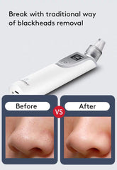 Facial Blackhead Cleaning Instrument - Mubimart -  