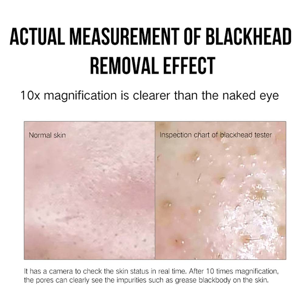 Facial Blackhead Remover - Mubimart