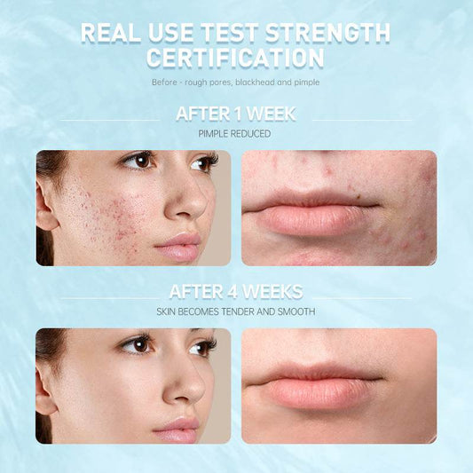 Salicylic Acid Repair Lotion Moisturizing And Repairing Sensitive Skin - Mubimart