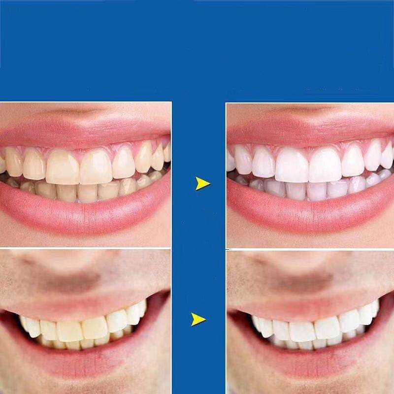 Tooth Whitening Gel Tooth Whitening Instrument Set - Mubimart